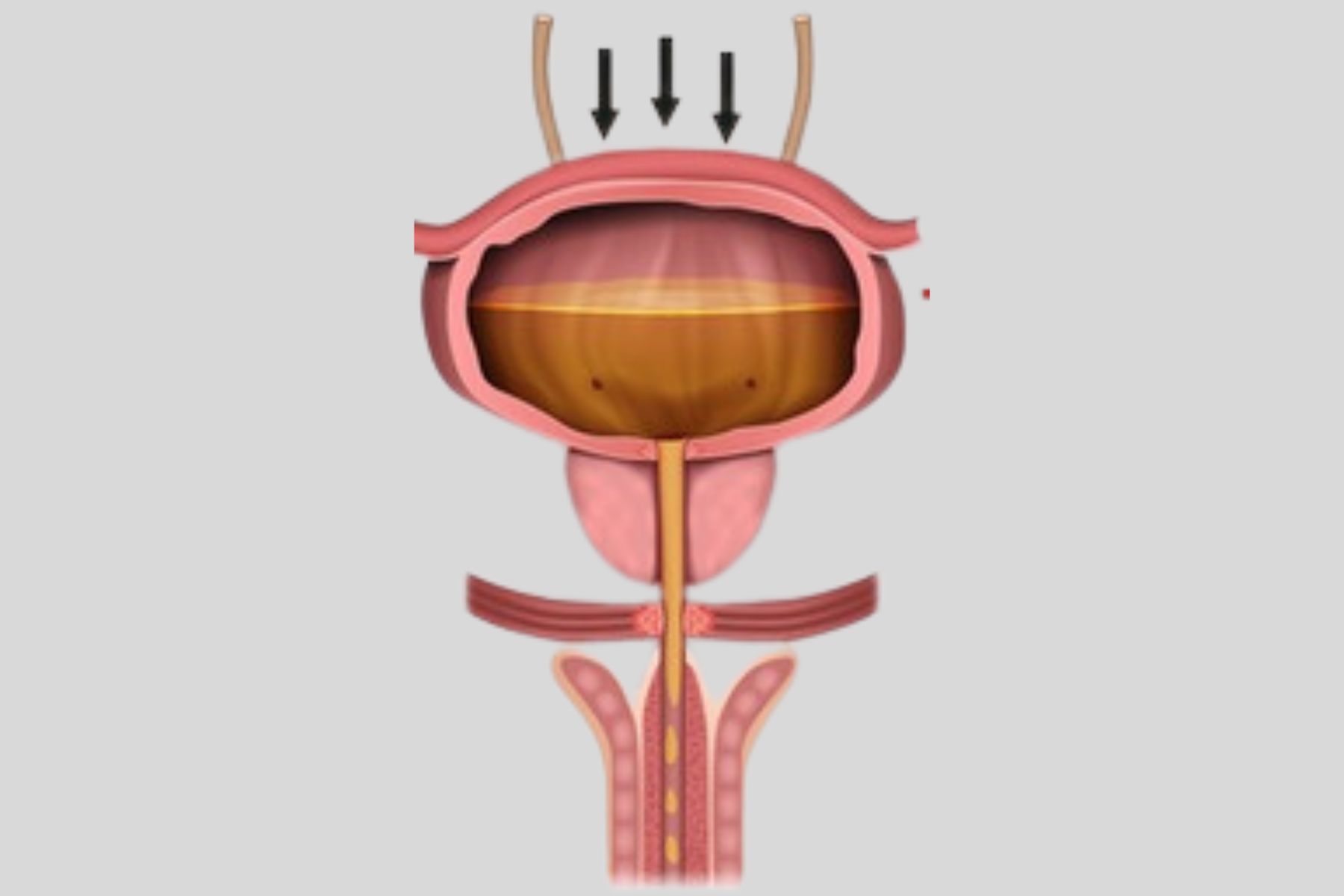 Belastungsinkontinenz