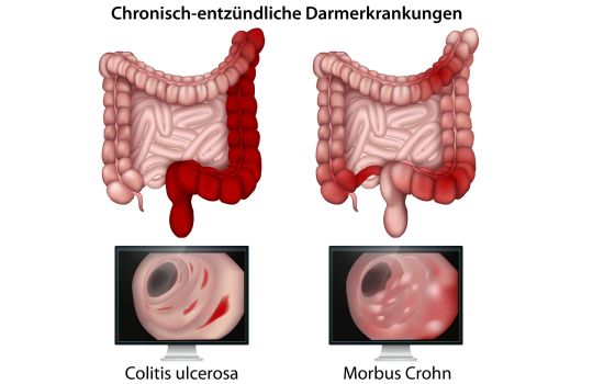 Chronisch - entzündliche Darmerkrankungen, betroffene Regionen