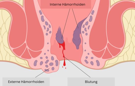 Hämorrhoiden