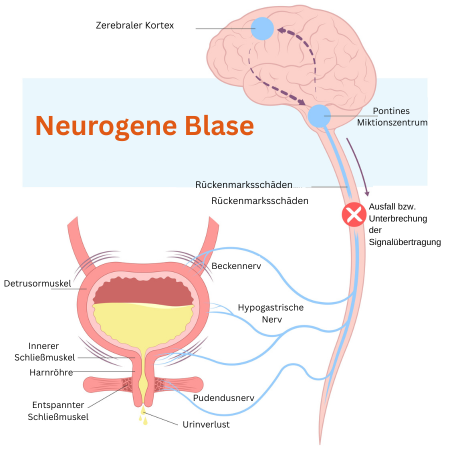 Neurogene Blase