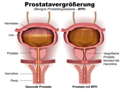 Prostatavergrößerung