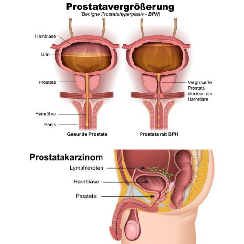 Benigne Prostatahyperplasie (BPH)