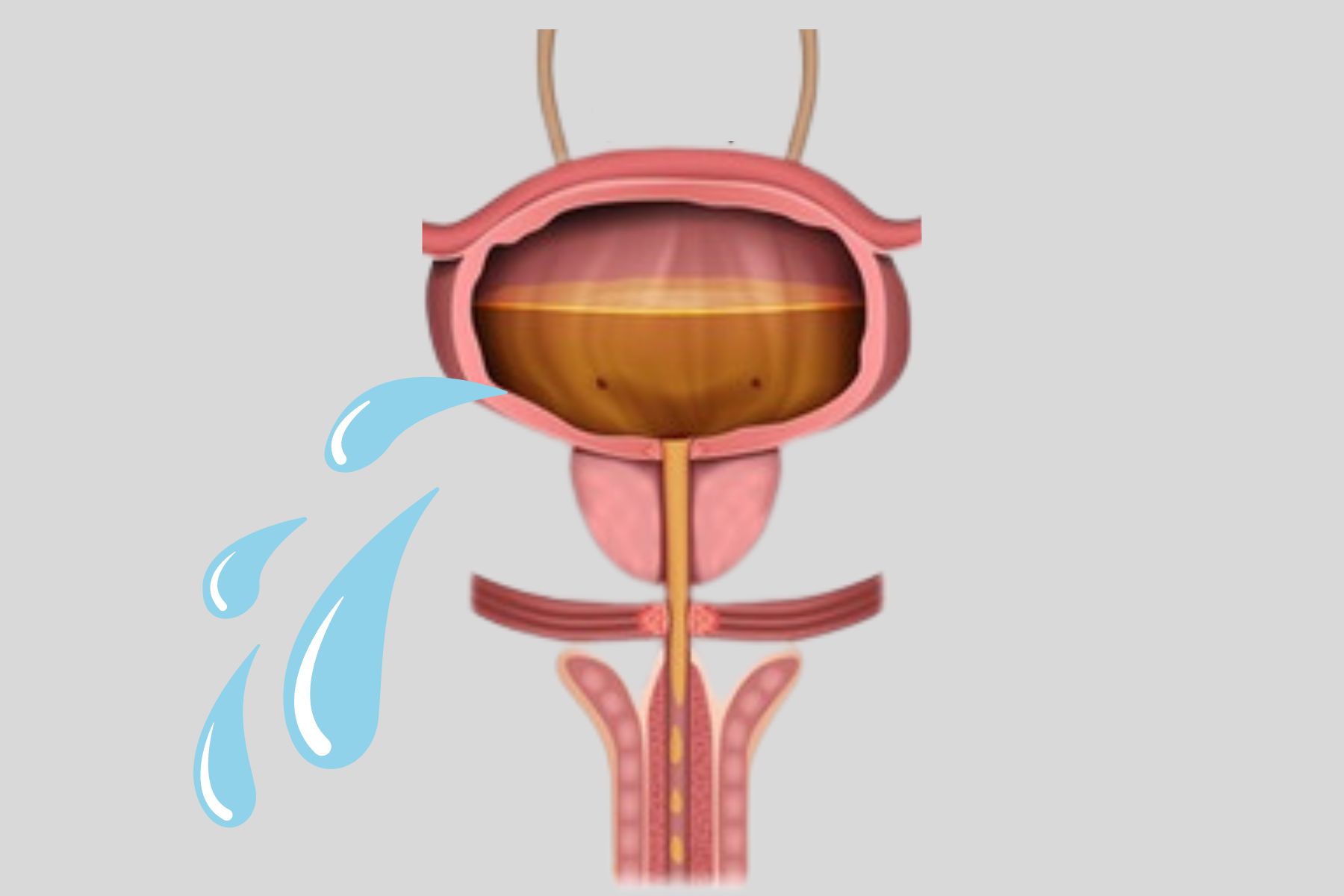 extraurethrale Inkontinenz