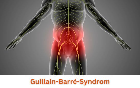 Guillain-Barré-Syndrom