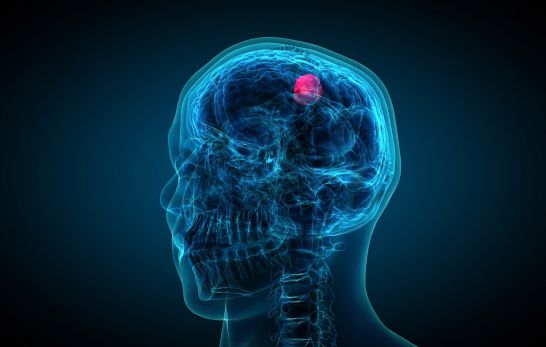 Hirntumor