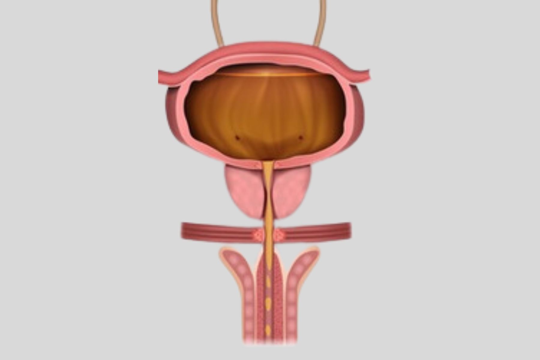 Überlaufinkontinenz