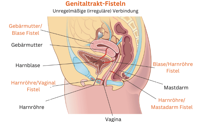 Fisteln an und zwischen Blase, Darm und Gebärmutter